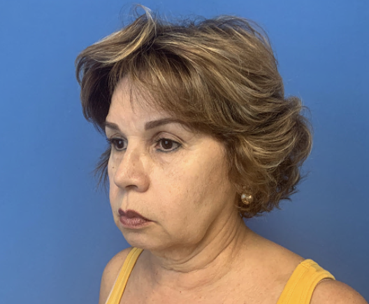 Lower-Face-and-Neck-Lift | Before Facelift